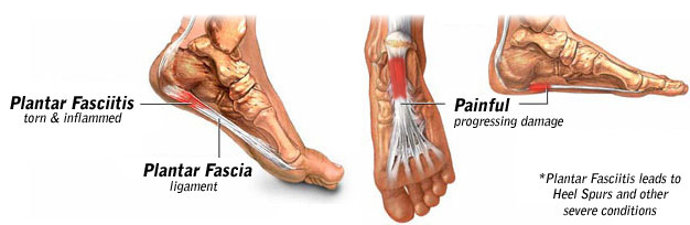plantar_fasciitis_diagram.jpg